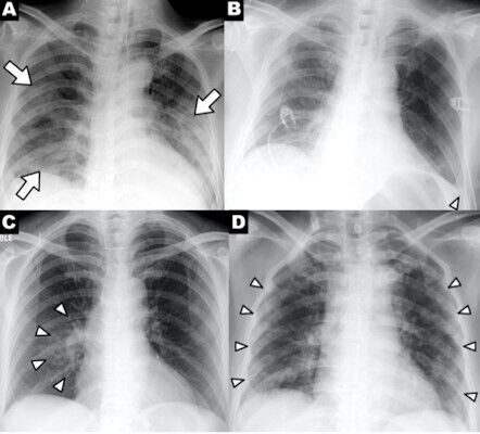 Серія рентгенівських знімків пацієнтів з COVID-19